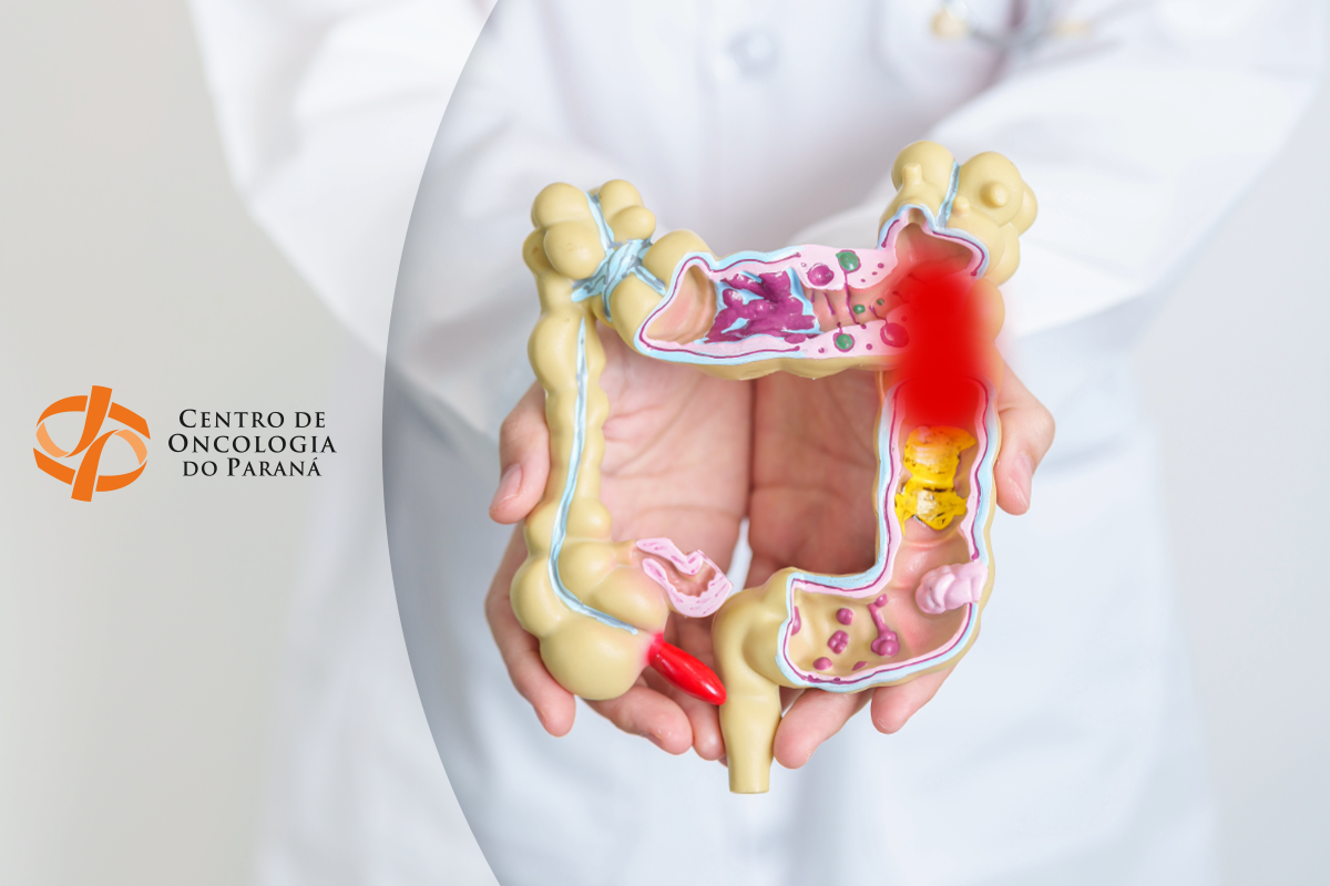 Estudo CheckMate 8HW abre novas perspectivas para o tratamento do câncer colorretal metastático